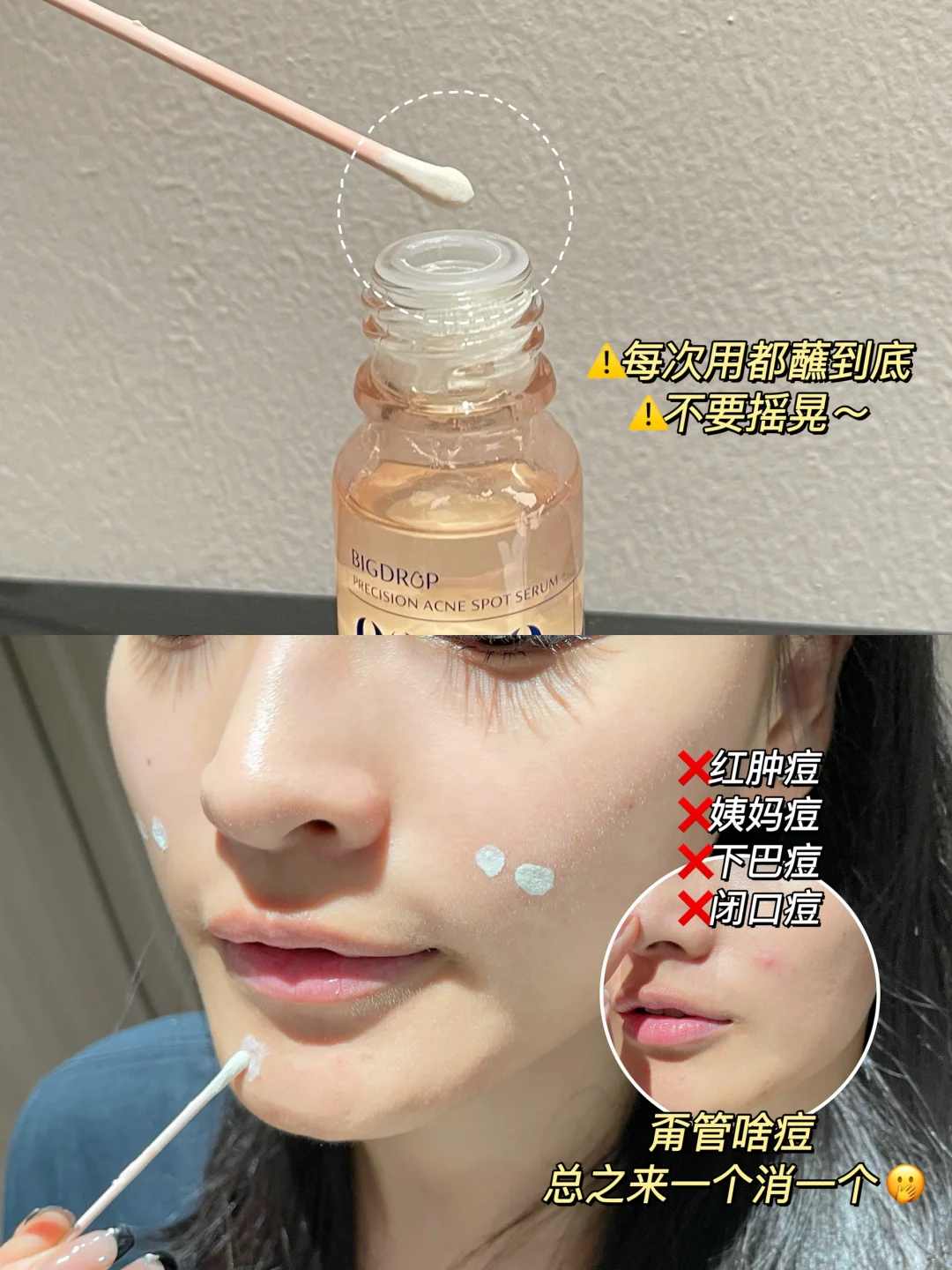 Tiktok/Douyin Hot BIGDROP Precision Acne Spot Serum 10ml 【Tiktok抖音爆款】大水滴精准祛痘点涂精华液