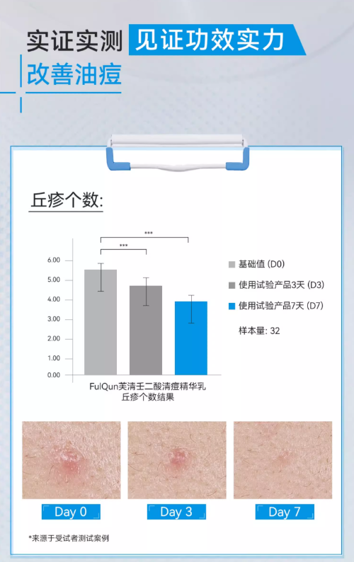 FulQun 20% Azelaic Acid Acne Essence Lotion 15g 芙清20%壬二酸清痘精华乳